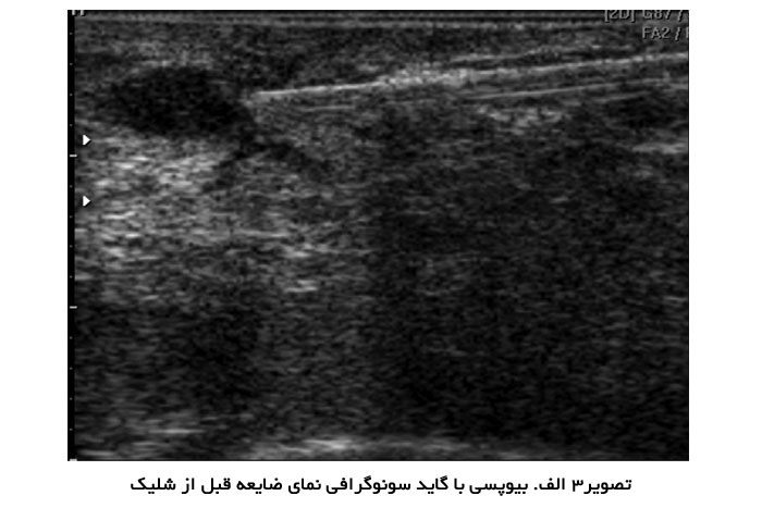 بیوپسی با گاید سونوگرافی نمای ضایعه قبل از شلیک